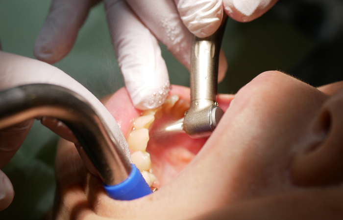 むし歯や歯周病、口臭の予防